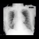 Aneurysm of thoracic aora: X-ray - Plain radiograph